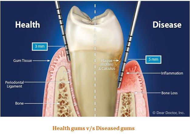 Gum Disease Treatment Services