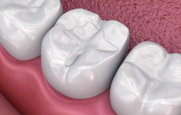 Pit And Fissure Sealants Treatment Services