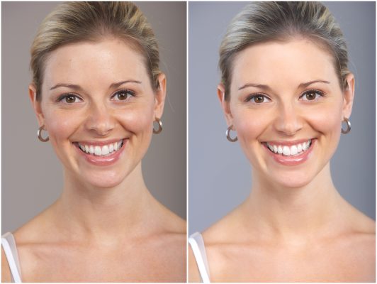 Smile Makeover Treatment Services