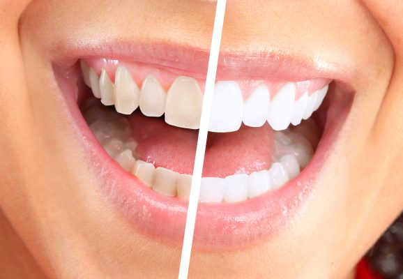 Teeth Whitening Treatment Services