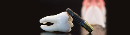 Implant Dentistry Treatment Services