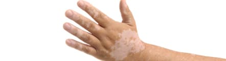 Vitiligo Surgery Treatment Services