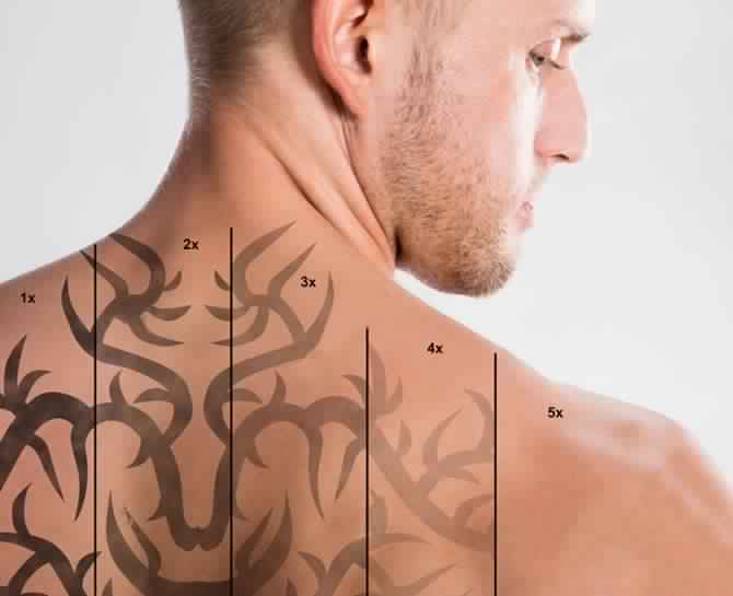 Tattoo Removal Treatment Service