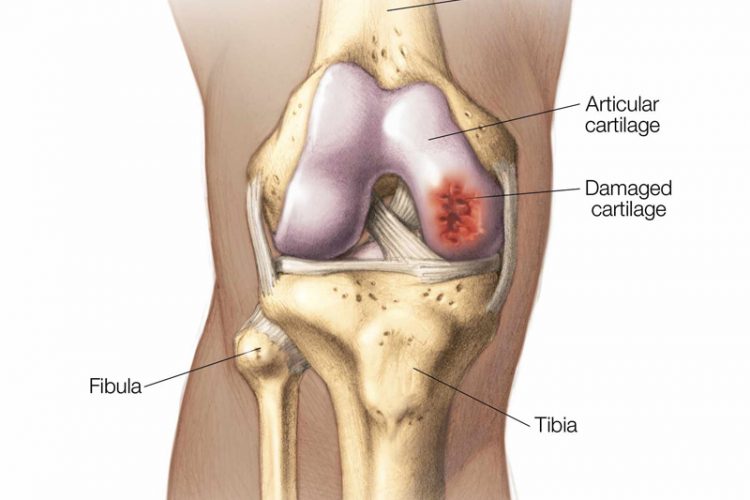 Cartilage Lesion Surgery