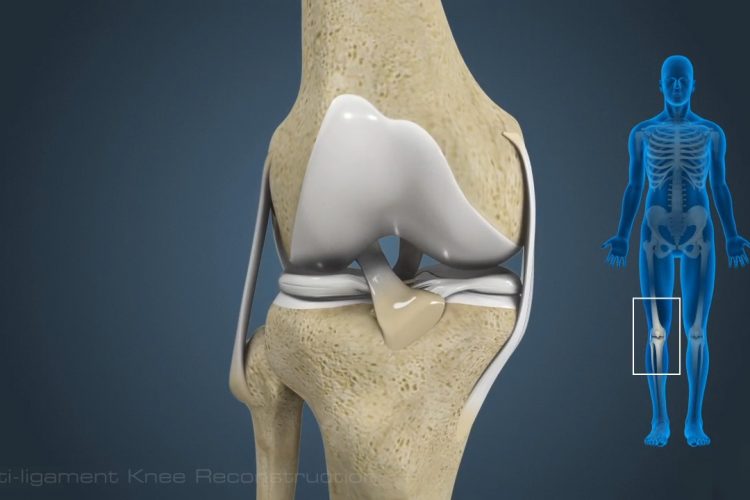 Multiligament Reconstruction Surgery