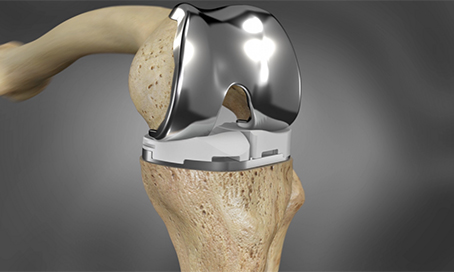 Partial Knee Replacement Surgery