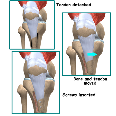 Patella Dislocation Treatment