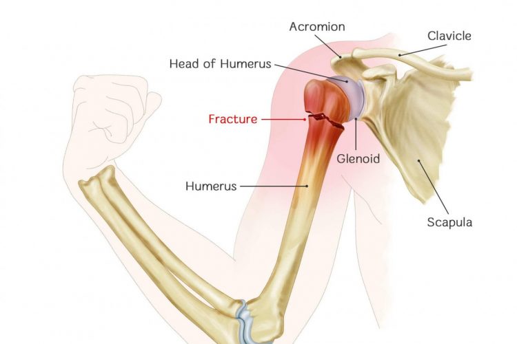 Shoulder Fractures Treatment