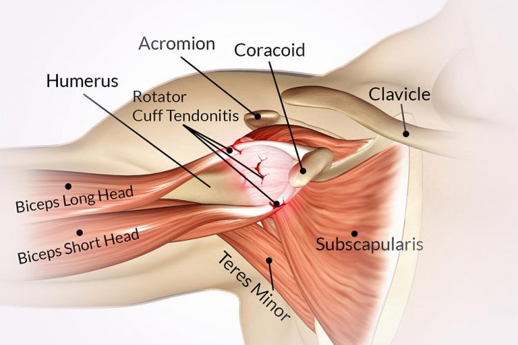 Shoulder Impingement Syndrome Surgery