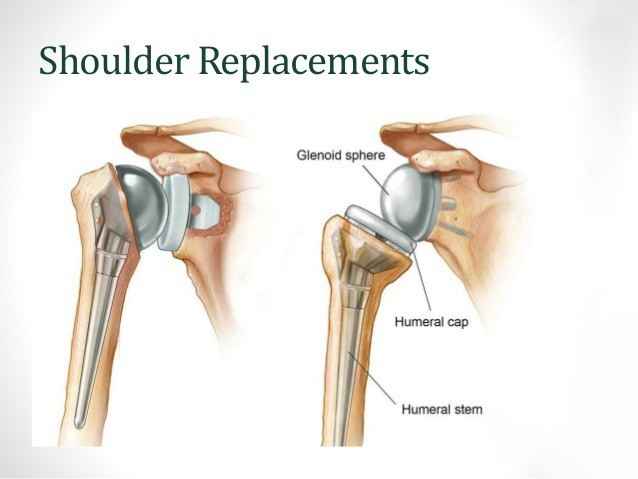 Shoulder Replacement Treatment Surgery