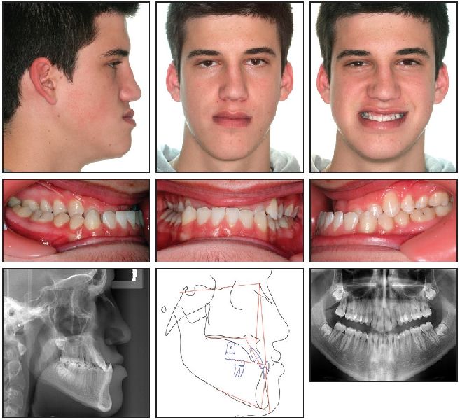 Correction Of Malocclusion