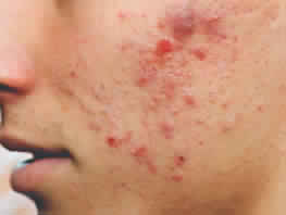 Pimple Control Peels Treatment