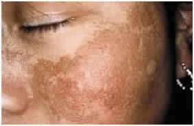 Skin Brightening Peels Treatment