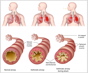 Services - Asthma and Allergy Treatment from Bangalore Karnataka India ...