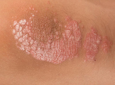 Psoriasis Treatment