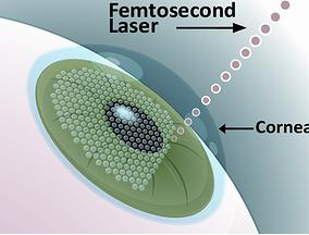 Bladeless LASIK in Mumbai