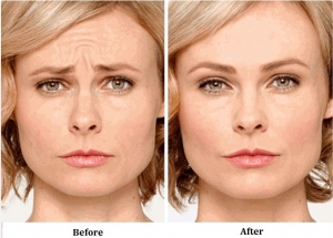 Blepharoplasty Treatment