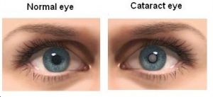 Cataract Surgery In Mumbai