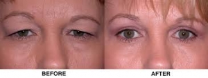 Cosmetic Eye Treatment