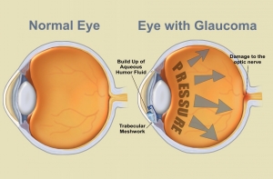 Glaucoma Treatment In Mumbai