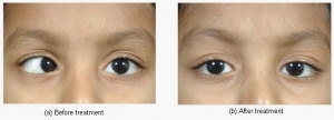 Paediatric Ophthalmology Treatment