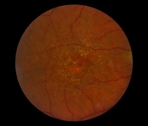 Retina Treatment In Mumbai