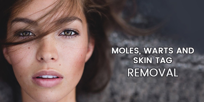 Skin Tags Removal Treatment in Gurgaon