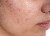 Acne Homeopathic Treatment Services