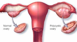 PCOS Homeopathic Treatment Services