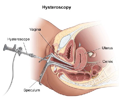 Hysteroscopy Treatment