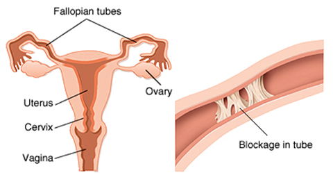 Infertility Surgeries