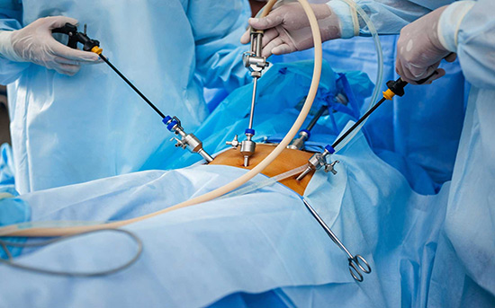 Laparoscopy Surgery