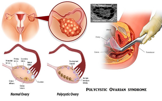 Polycystic Ovary Syndrome (PCOS)