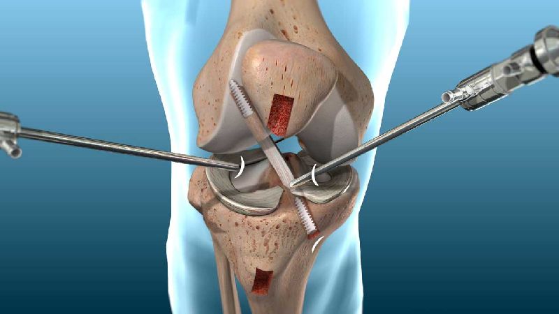 ACL Reconstruction Surgery in India