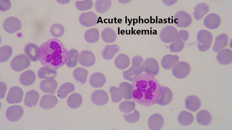 Acute Lymphocytic Leukemia Treatment in India