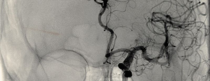 Angiography in India