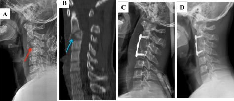 Anterior Cervical Corpectomy Spine Surgery Price In India at Best Price ...