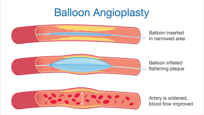 Balloon Angioplasty in India