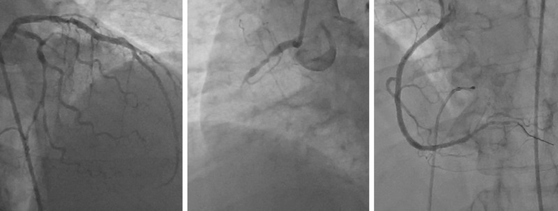 Coronary Angiogram in India