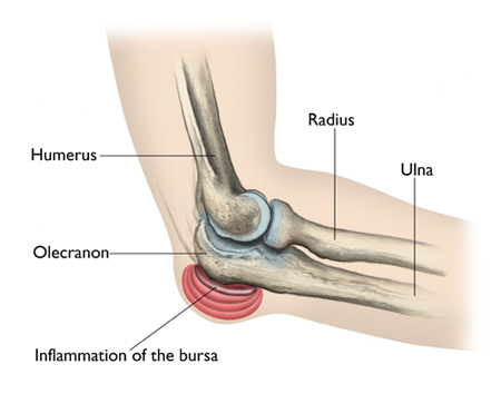 Elbow Replacement Surgery In India
