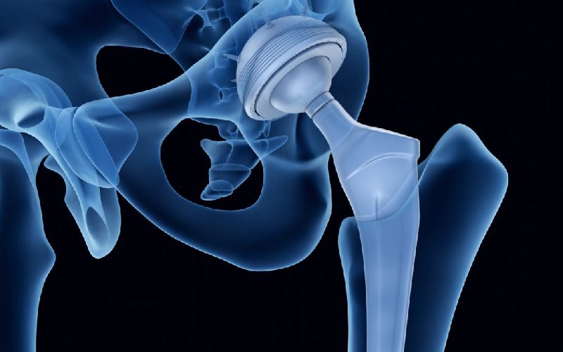 Hip Replacement Surgery in India