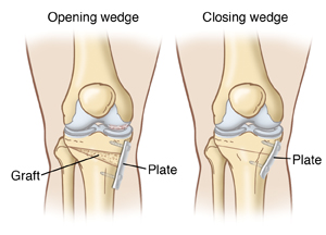 Osteotomy in India