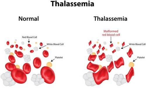 Thalassemia Treatment In India