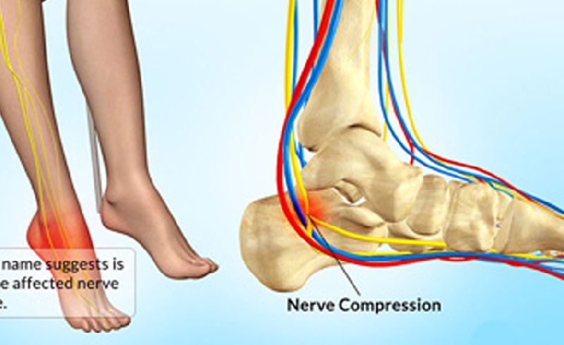 Nerve Compression Treatment