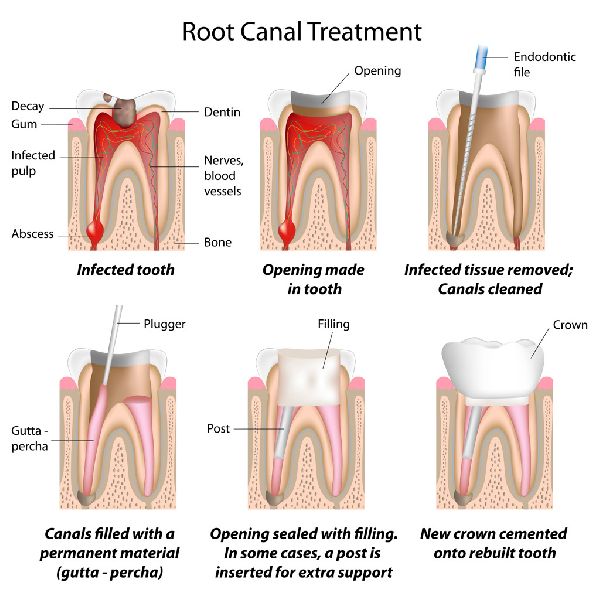 Endodontics Treatment Services