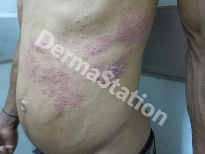 Herpes Zoster Treatment