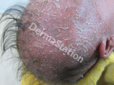 Seborrheic Dermatitis Treatment