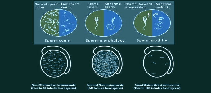 Azoospermia Treatment