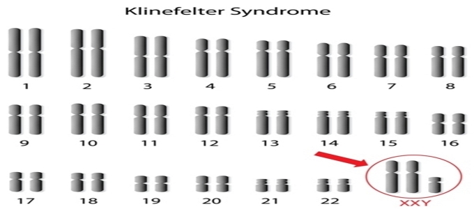 Klinefelter System Treatment