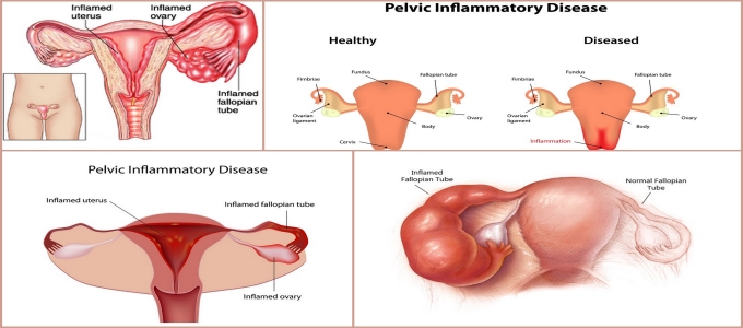 Pelvic Inflammatory Disease Treatment